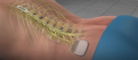 paddle lead spinal cord stimulator